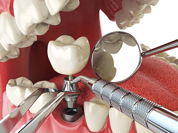 Best Emergency Dental Care for Broken or Chipped Teeth in Bishopville, SC
