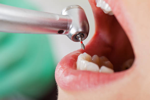 Best Emergency Tooth Extraction in Bishopville, SC